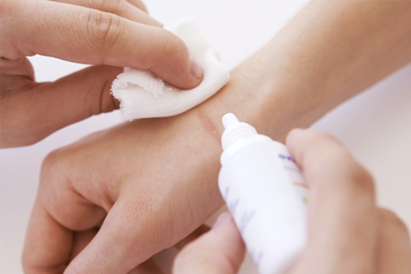 disinfettare una ferita alla mano